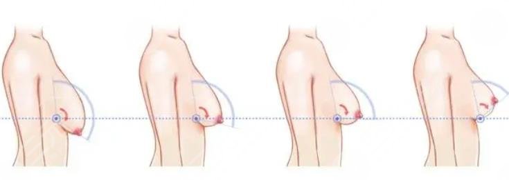 乳房缩小提升