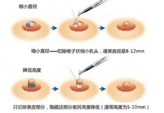 乳房缩小提升