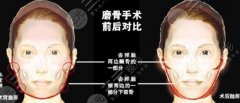 磨骨手术从哪里开刀口？颌面整形超全科普知识分享，不当小白鼠！