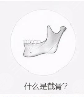 下颌角磨骨