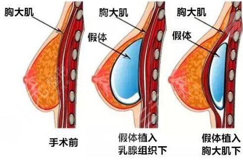 泊欧峰隆胸果怎么样?