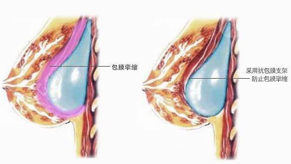 泊欧峰隆胸术后需要多久恢复?