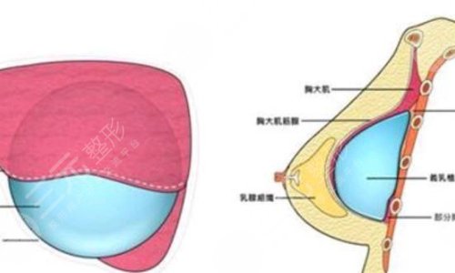 泊欧峰隆胸手术之前需要做好哪些准备工作?