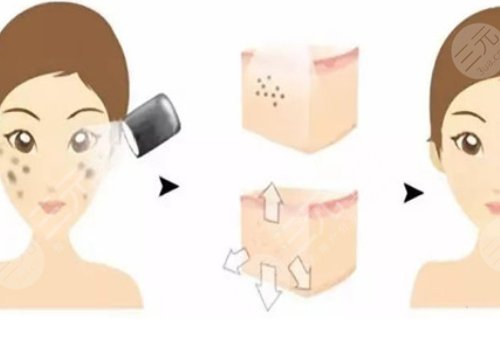 光子嫩肤祛斑禁忌人群