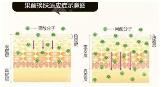 果酸换肤的功是什么