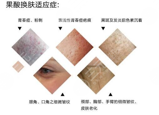 果酸换肤适合哪些人群?禁忌人群有哪些?