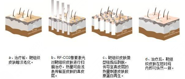 像素激光和点阵激光哪个果好?各优势盘点!医美小白收藏~ 像素激光和点阵激光哪个果好?各优势盘点!医美小白收藏~