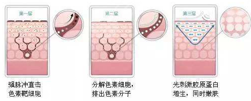 像素激光和点阵激光哪个果好
