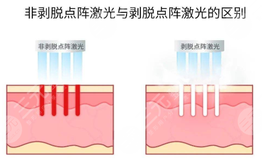 点阵激光优势盘点