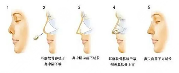 美鼻攻略|耳软骨隆鼻可以维持多久？术前准备+术后护理盘点！