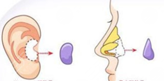 耳软骨隆鼻术前准备工作：