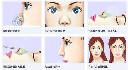耳软骨隆鼻术后护理知识：