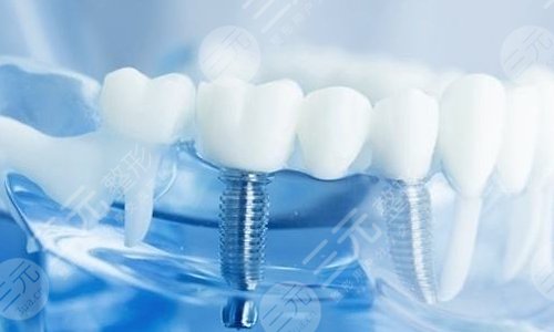 口腔问答一:种植牙寿命是多少年?