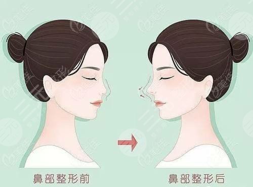九院隆鼻案例术前