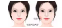 前十天，全脸脂肪填充感觉好丑！熬过恢复期才真正蜕变~