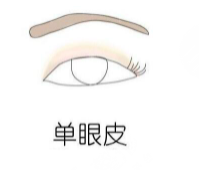 双眼皮术后恢复过程图