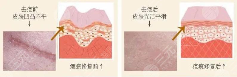 深圳激光去疤痕有吗?