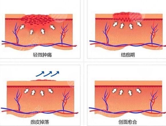 深圳激光去疤痕有吗?