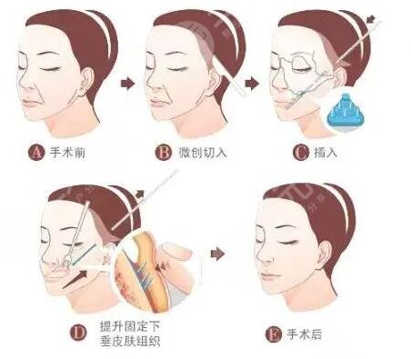 什么是拉皮整形美容项目？