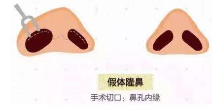 什么是鼻部手术手术项目？