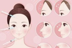 自体脂肪填充面部能保持多长时间？超全资料科普，优点&注意事项get！