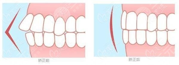 华西口腔医院牙齿矫正前