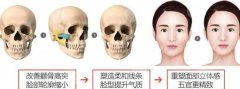 磨骨整形大概多少钱？价格参考+手术知识，超全科普术前必备！