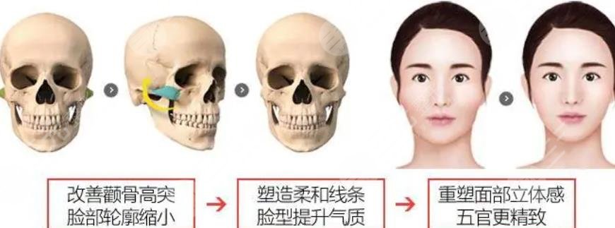 颧骨内推