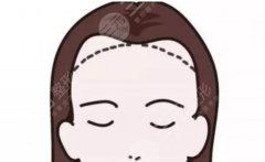 植发际线能保持多久？科普手术特点&注意事项，keep你的美！