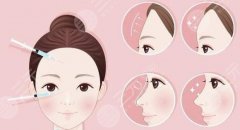 额头脂肪填充多少钱？丰额头参考价格分享，术前必看常识！