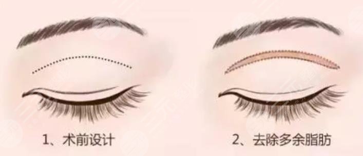 双眼皮