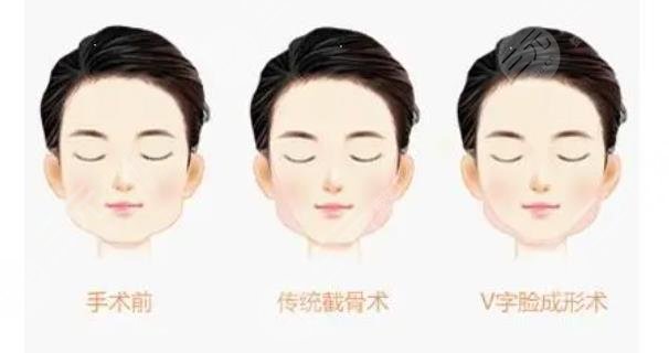 男士整形