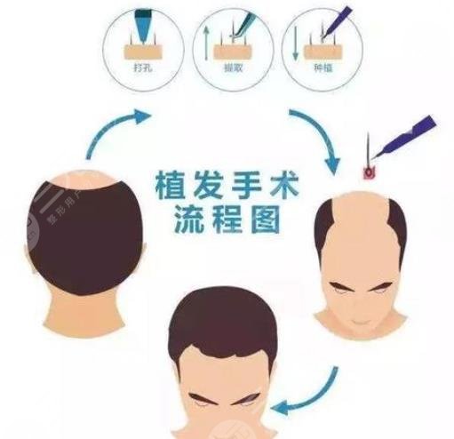 植发