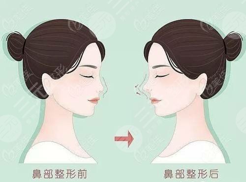 河北省第一人民医院整形科怎么样?纤巧的鼻子值得拥有！