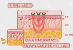 热玛吉有什么果和副作用?如何让皮肤重返年轻? 热玛吉有什么果和副作用?如何让皮肤重返年轻?