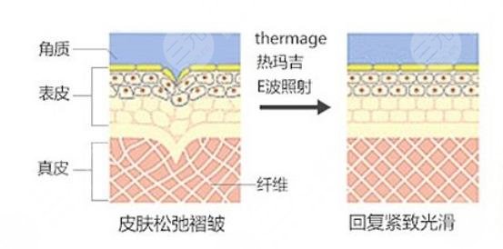 热玛吉是什么原理