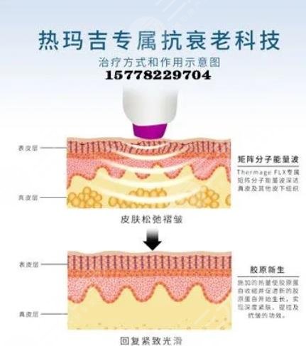热玛吉是什么原理