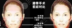 磨骨手术有什么风险和后遗症吗？讲解4级手术那些不为人知的秘密！