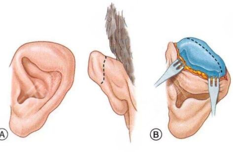 耳再造手术