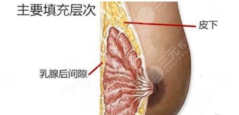 隆胸