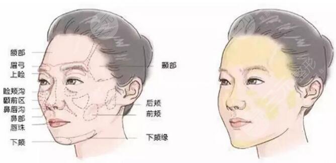北京欧亚美医疗美容诊所面部脂肪填充果图案例：术后