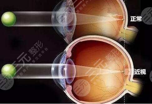 北京大学深圳医院近视激光手术