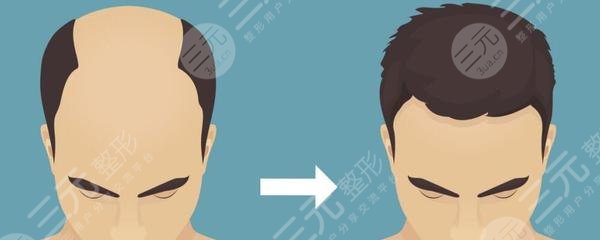 上海九院植发果图