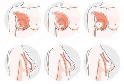 魔滴假体隆胸为什么价格有高有低?