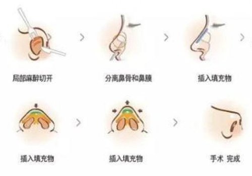 假体隆鼻