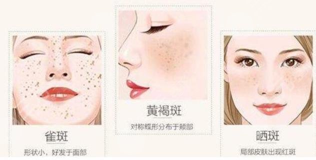 香港大学深圳医院皮肤美容相关项目案例：祛斑_术前