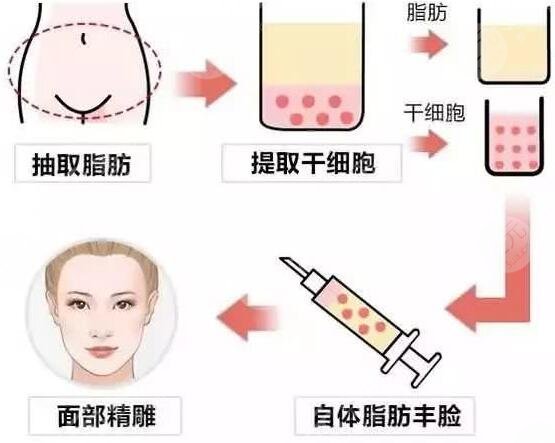 自体脂肪填充颞部 自体脂肪填充后恢复图