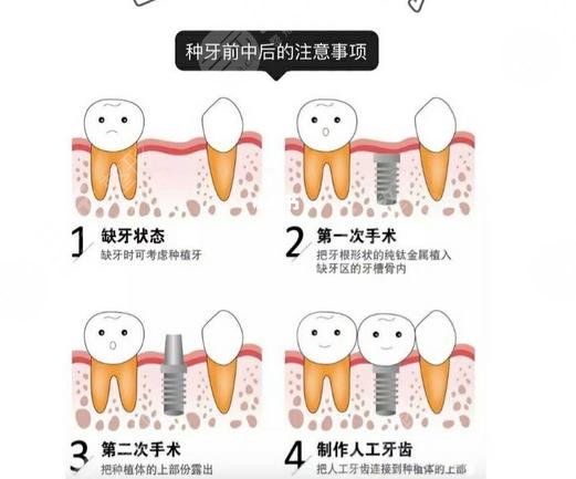 广州中医药大学第一附属医院牙科种植牙案例：术后