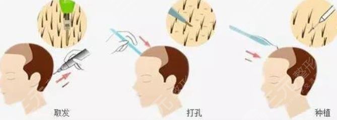 深圳北大医院植发科普介绍