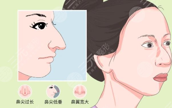 鹰钩鼻矫正